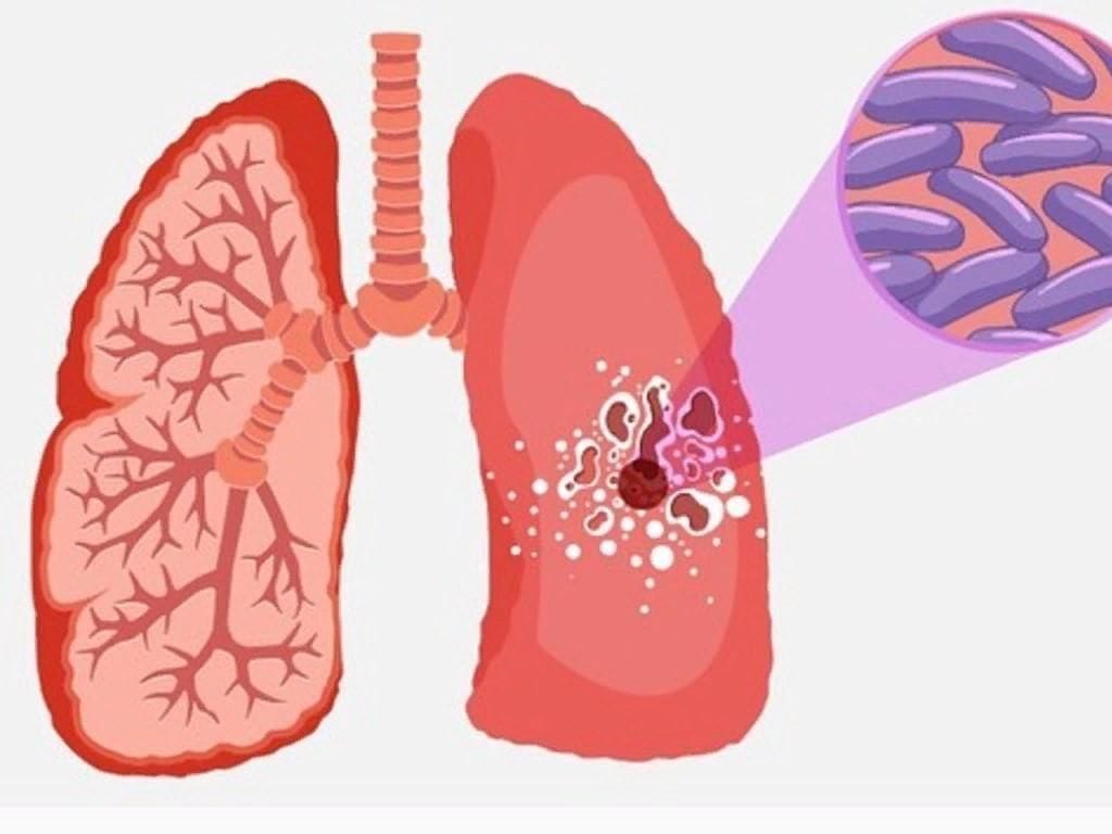 Туберкулез картинки для презентации